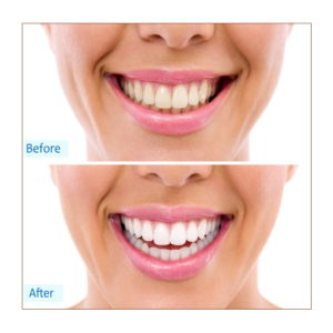 What teeth whitening gel do dentists use